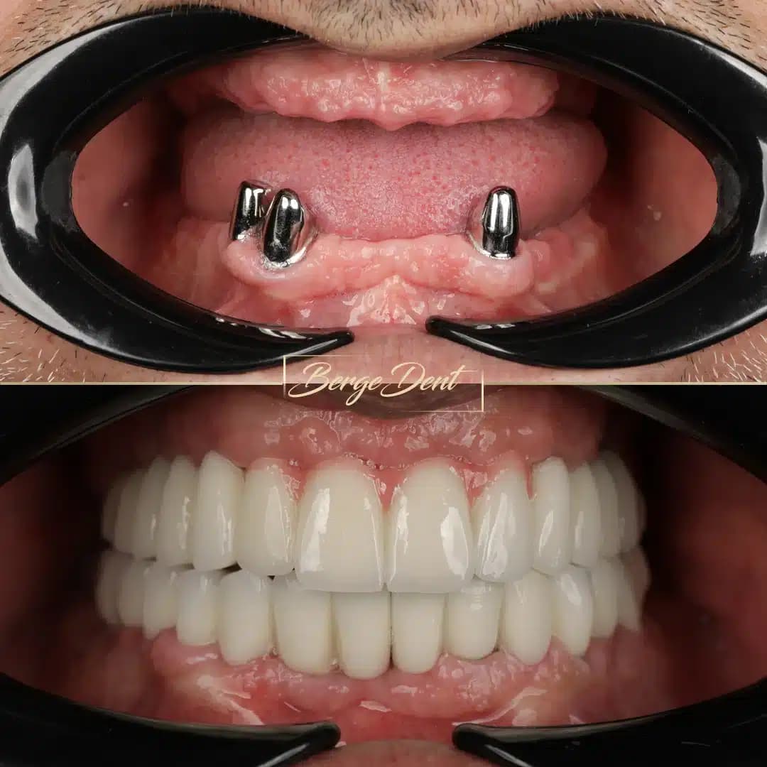 full mouth implants in turkey