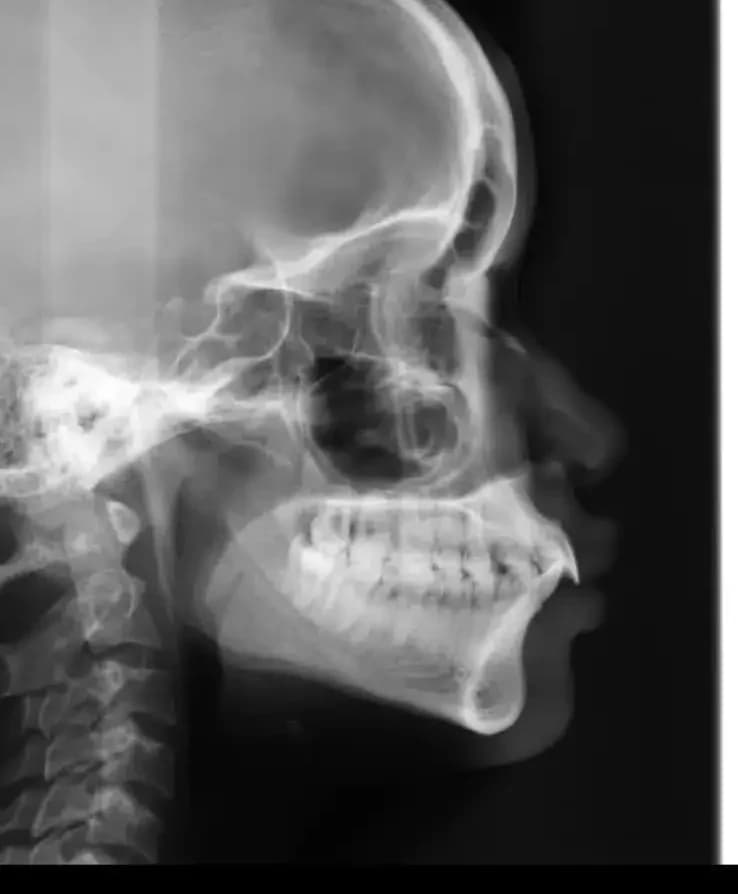 1 full mouth implants in turkey