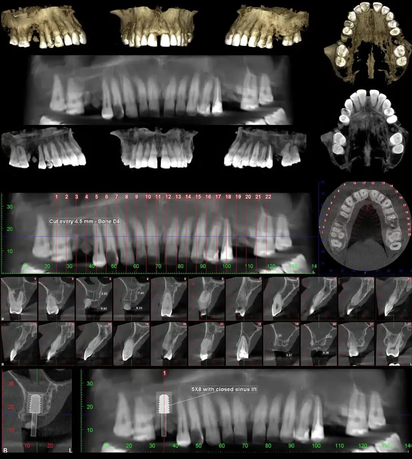 full mouth implants in turkey