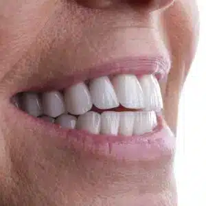 all on 6 dental implants in turkey