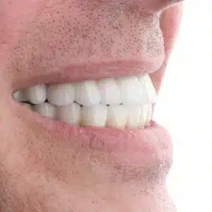 all on 4 full mouth dental implants in turkey