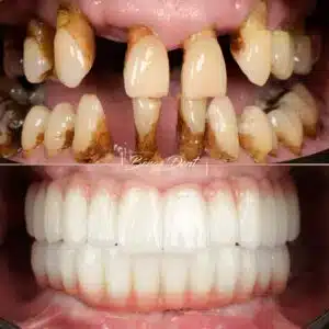 all on 6 full mouth dental implants in turkey