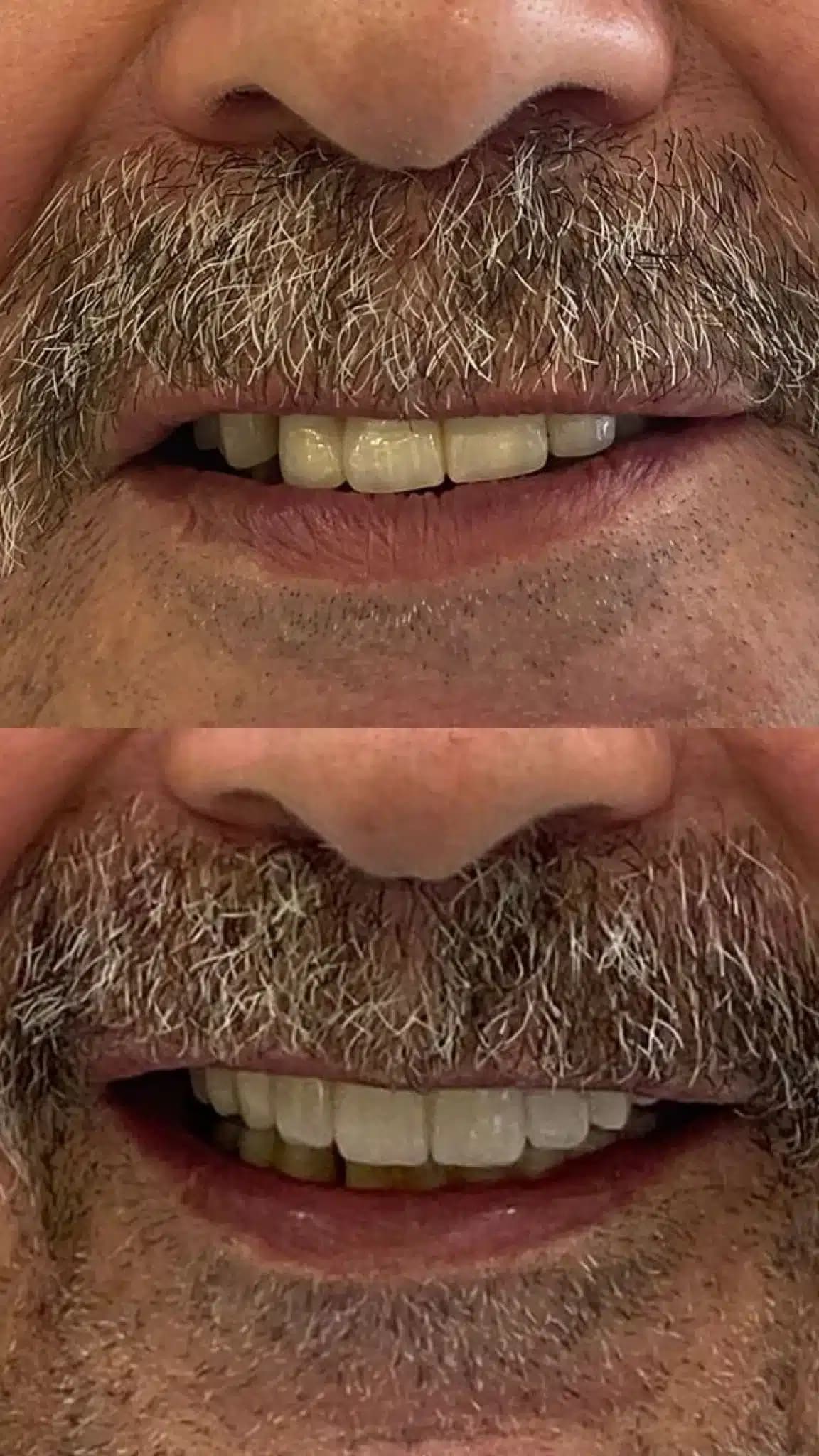 corticobasal implants 3 days full mouth