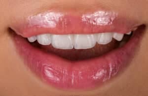 full mouth dental implant