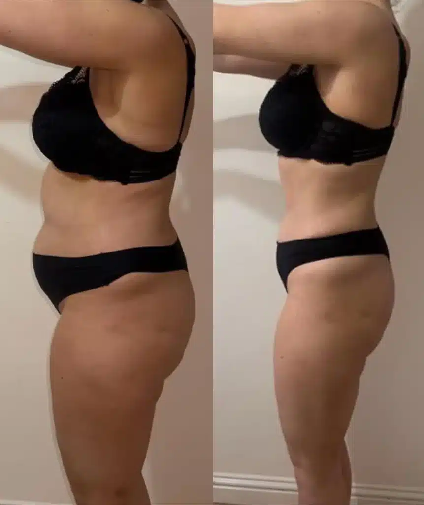 Diagram comparing Fleur-de-Lis and Extended Tummy Tuck incision patterns