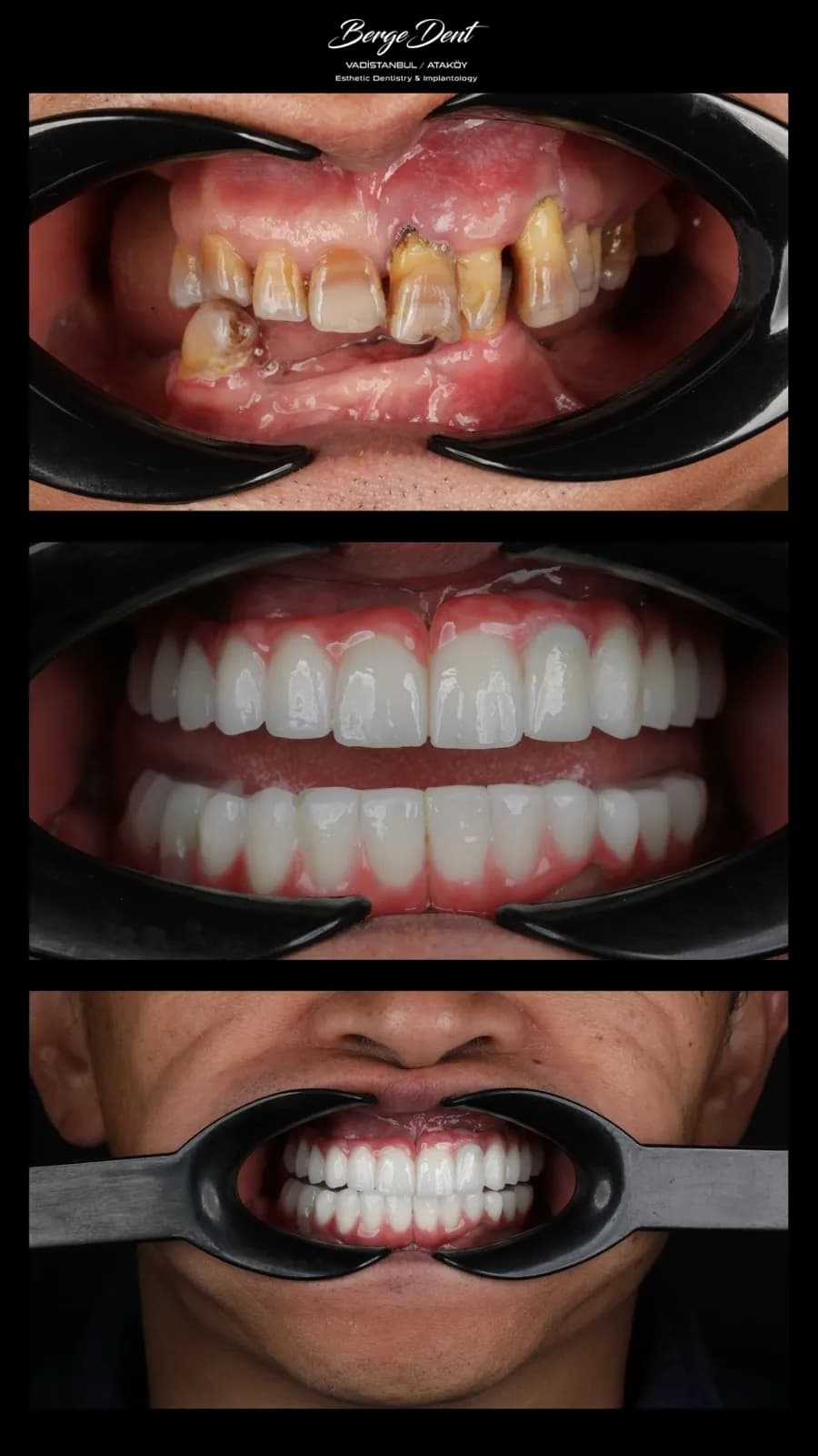 Close-up before and after dental restoration photos showing severely worn decayed teeth transformed into white ceramic crowns, Turkey dental clinic case.