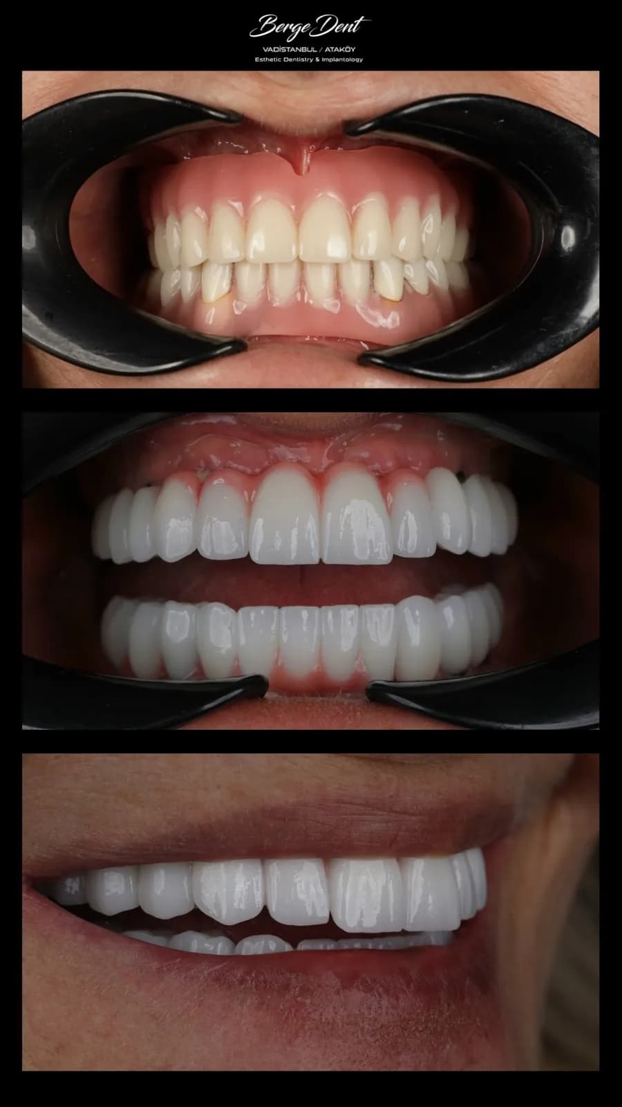 Close-up before and after dental restoration images showing severely damaged teeth transformed into a full set of white ceramic crowns, Turkey dental clinic case.