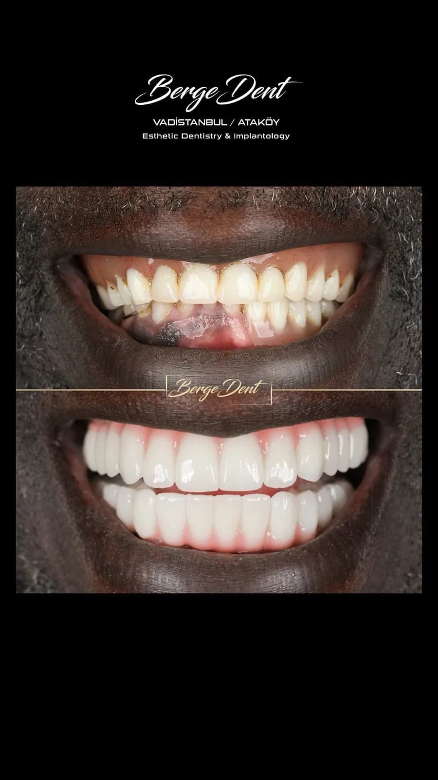 Before and after full face and smile comparison showing a patient's damaged, discolored teeth transformed into a bright white smile after dental restoration, Turkey dental clinic case.