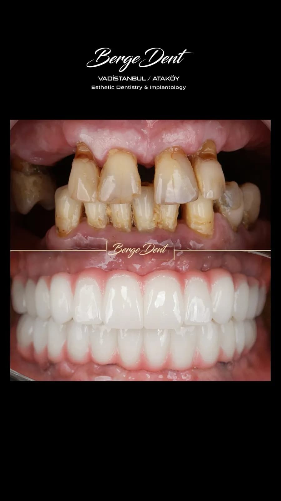 Extreme close-up before and after dental photos showing severely worn and decayed teeth transformed into a bright white ceramic restoration, Turkey dental clinic case.