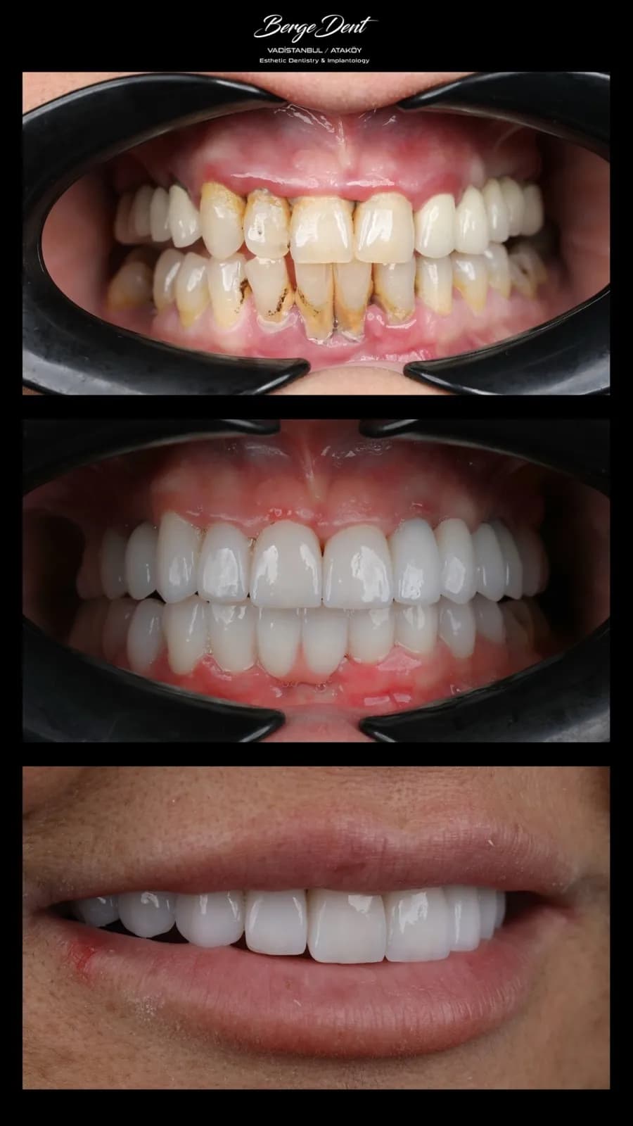 Dental before and after mouth close-up, stained and worn teeth transformed into bright even white restorations, Turkey dental clinic.
