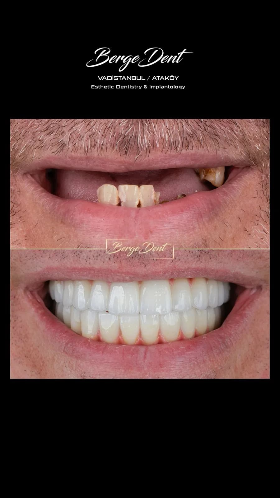 Male patient before and after dental treatment close-up, missing and broken front teeth restored with a full white smile, Turkey dental clinic.
