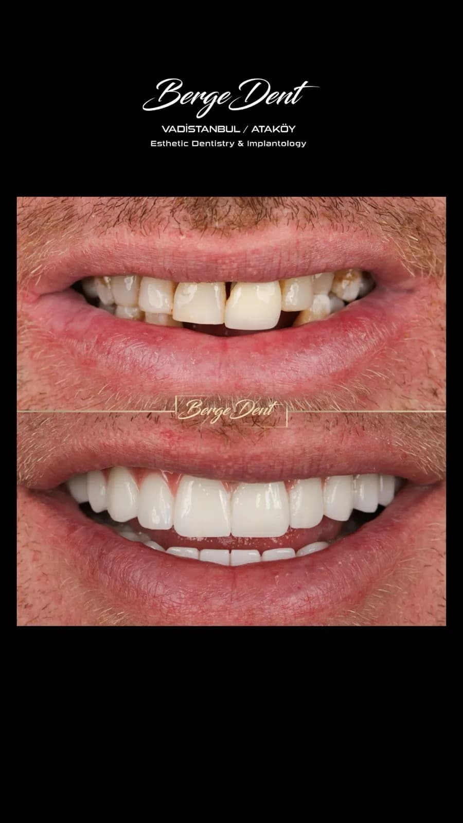 Male patient before and after dental restoration close-up, chipped and gapped teeth transformed into an even white smile, Turkey dental clinic.