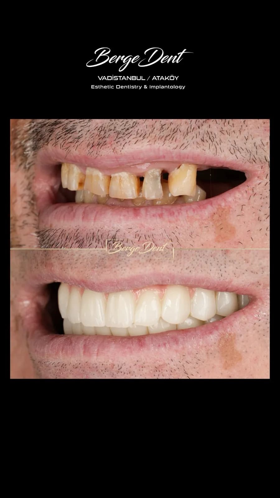Side-angle before and after dental close-up, severely worn and stained teeth restored to a natural white smile, Turkey dental clinic.