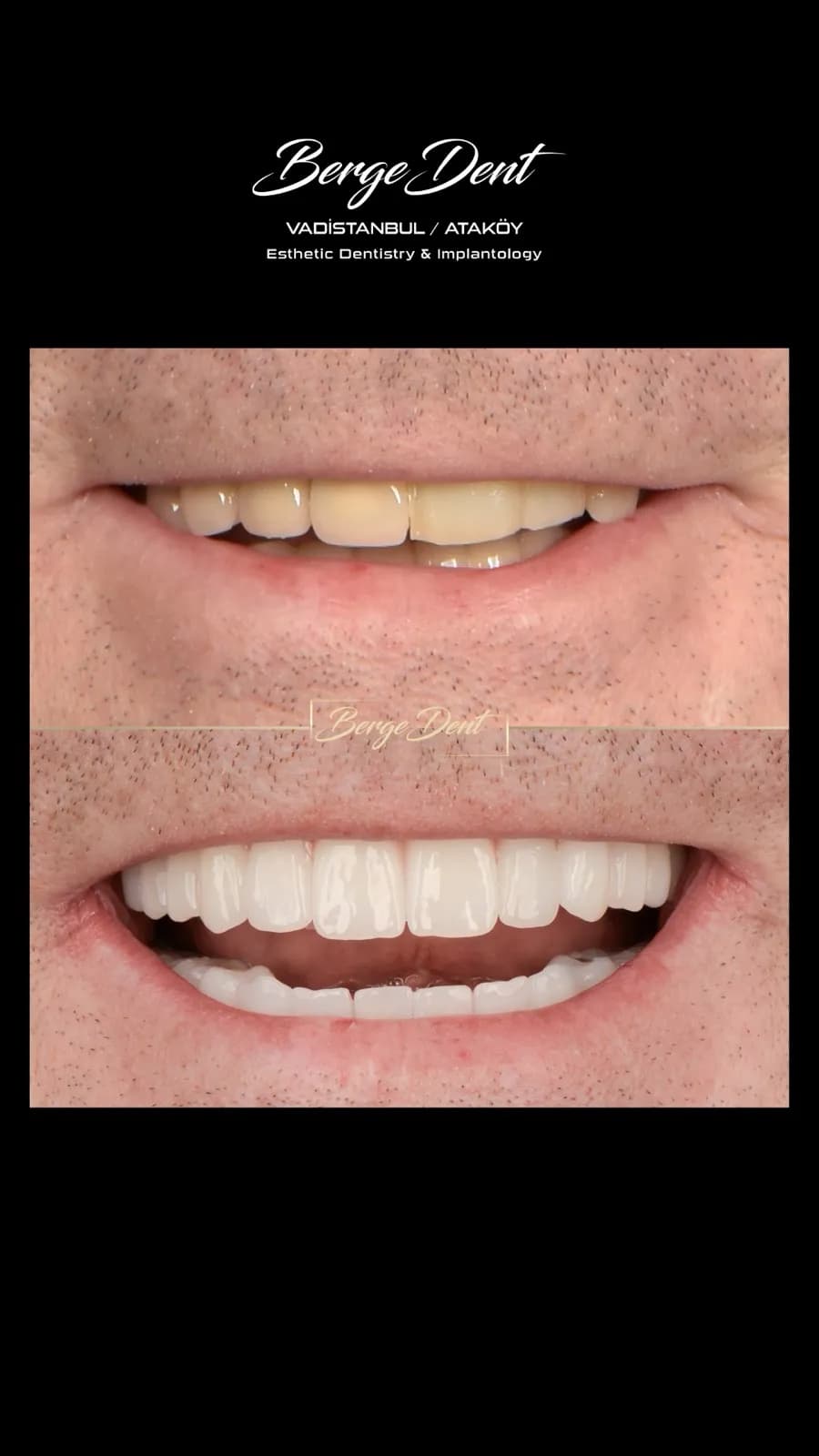 Male patient before and after dental close-up, gapped worn teeth restored to a uniform white smile, Turkey dental clinic.