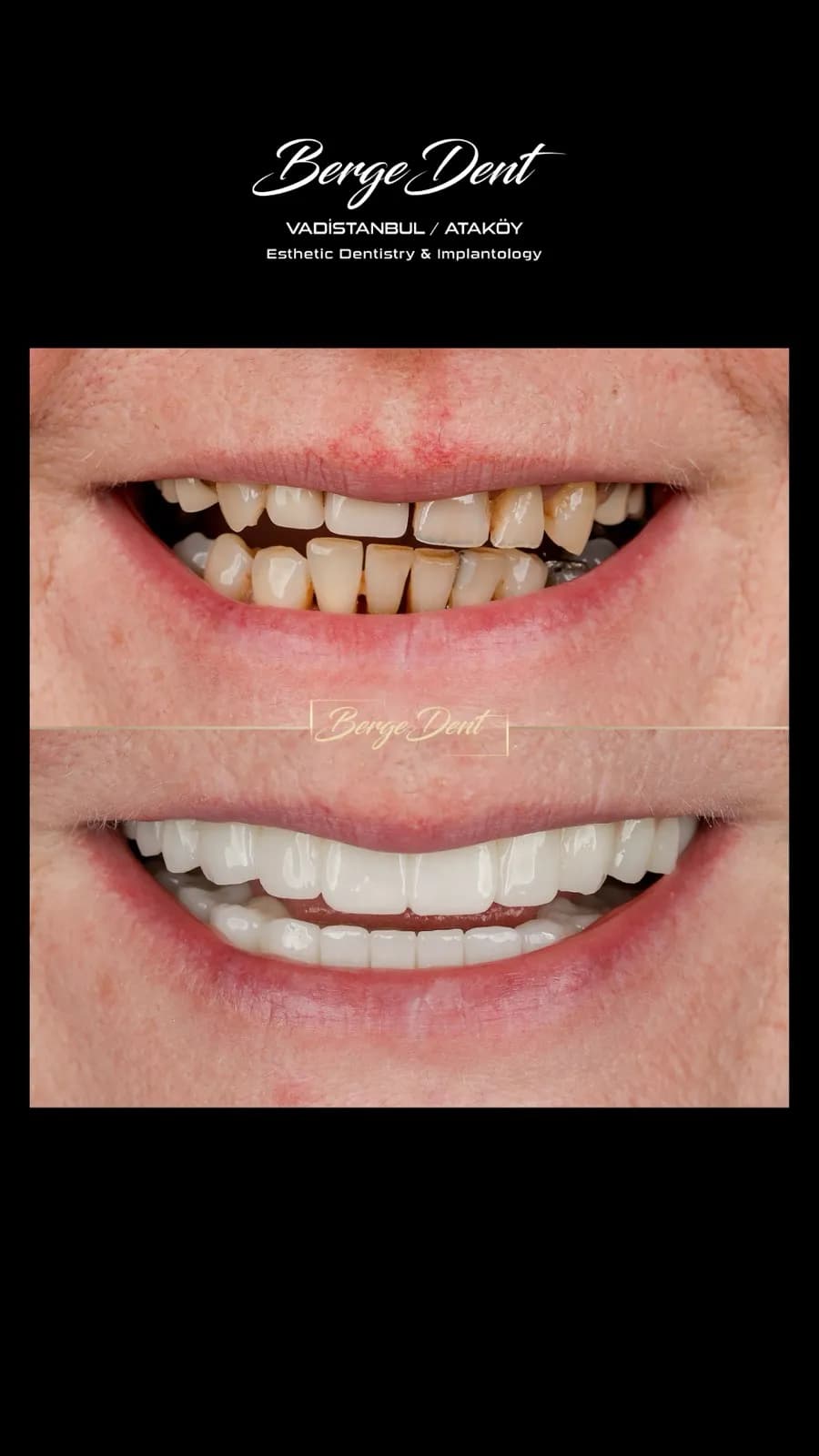 Before and after dental transformation: severely broken and decayed teeth with gaps compared to a bright white complete smile restoration, Turkey dental clinic.