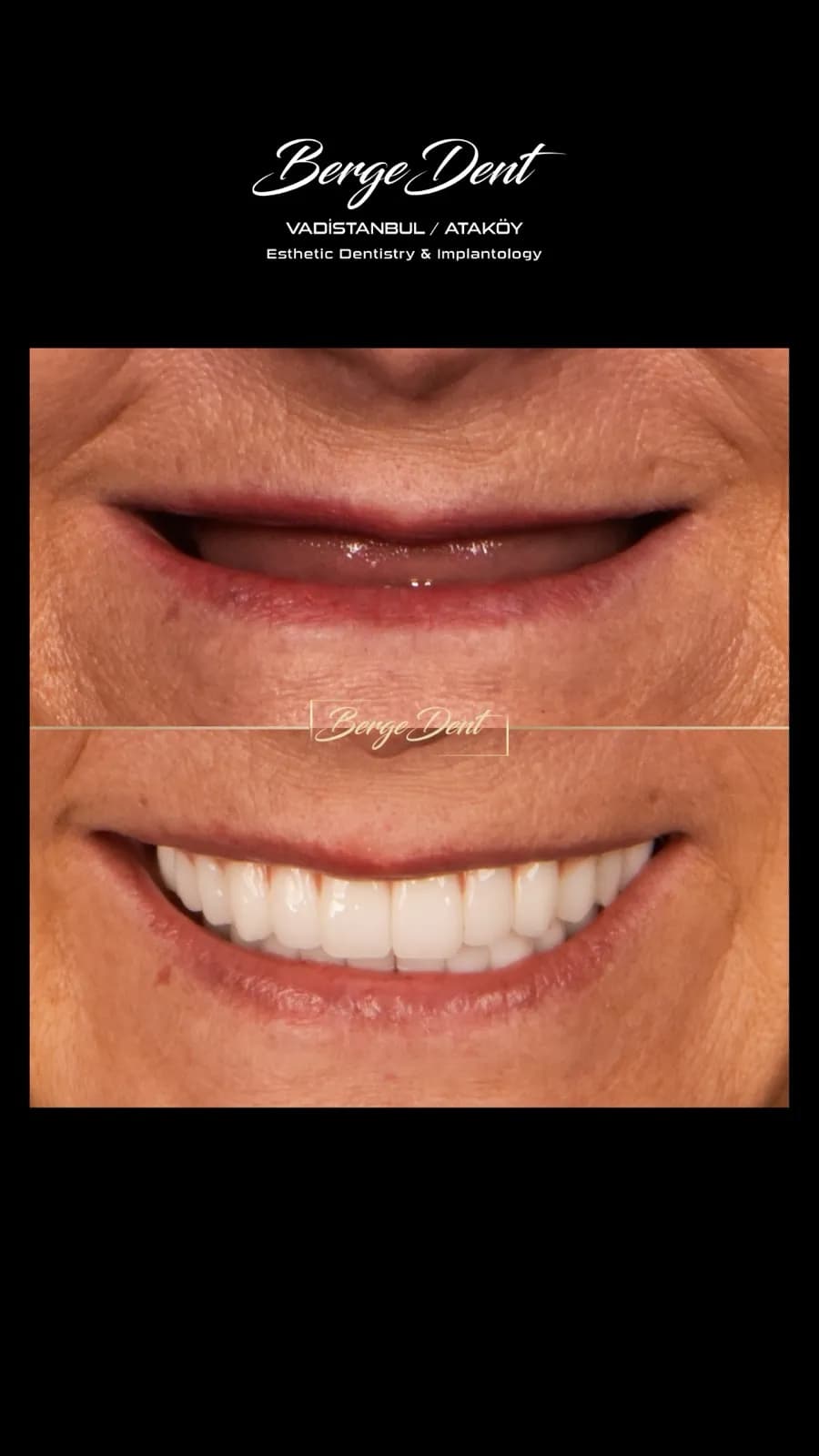Before and after dental transformation, lower face view: closed natural lips compared to an open bright white smile after full-arch restoration, Turkey dental clinic.