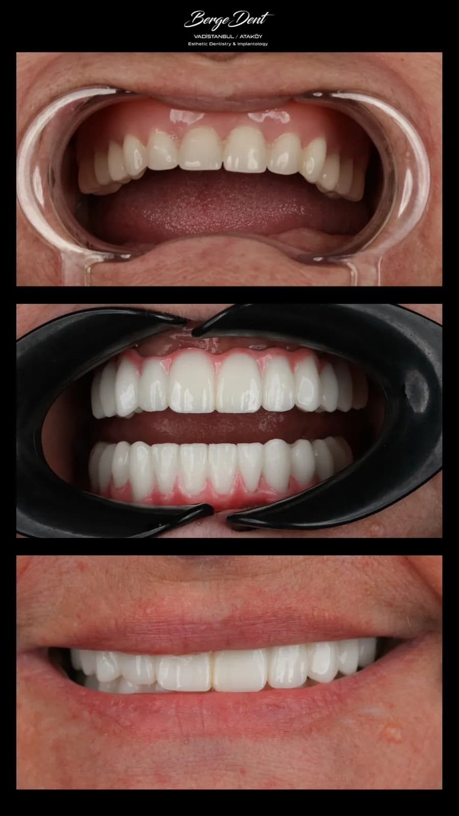 Full arch dental restoration before and after, intraoral try-in and final white ceramic result, close-up smile, Turkey dental clinic.