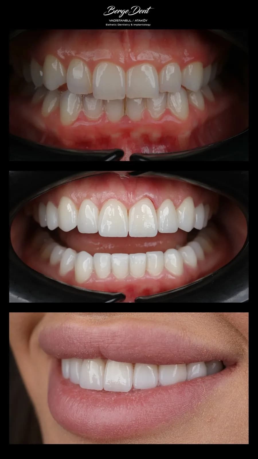 Full mouth dental restoration before and after, close-up of discolored worn teeth transformed to a white smile, Turkey dental clinic.