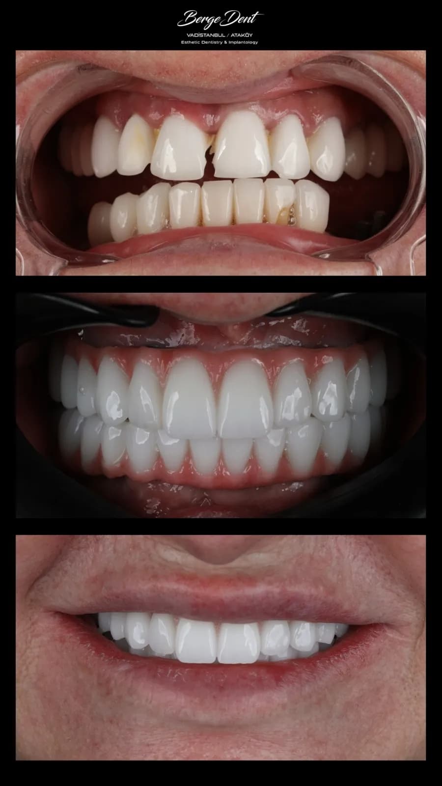 Full mouth dental restoration before and after, close-up of broken and missing front teeth transformed into a complete white smile, Turkey dental clinic.