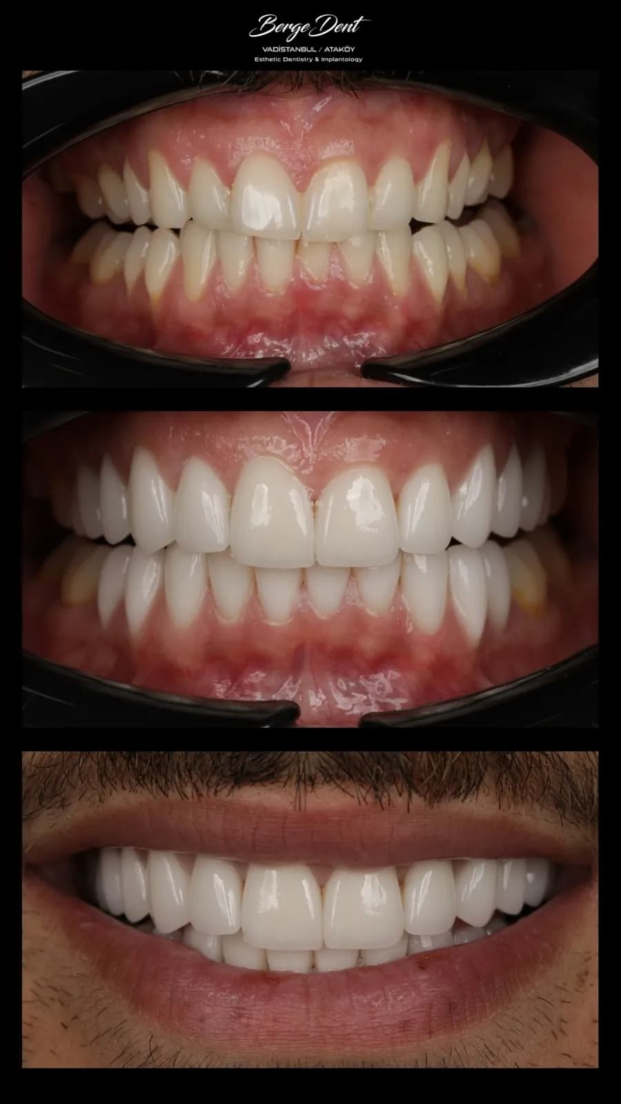 Full mouth dental restoration before and after, close-up of worn yellowed teeth transformed into a bright white smile, Turkey dental clinic.
