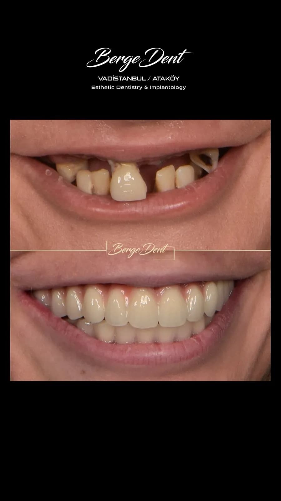 Full mouth dental restoration before and after, close-up of missing and broken front teeth transformed into a complete white smile, Turkey dental clinic.