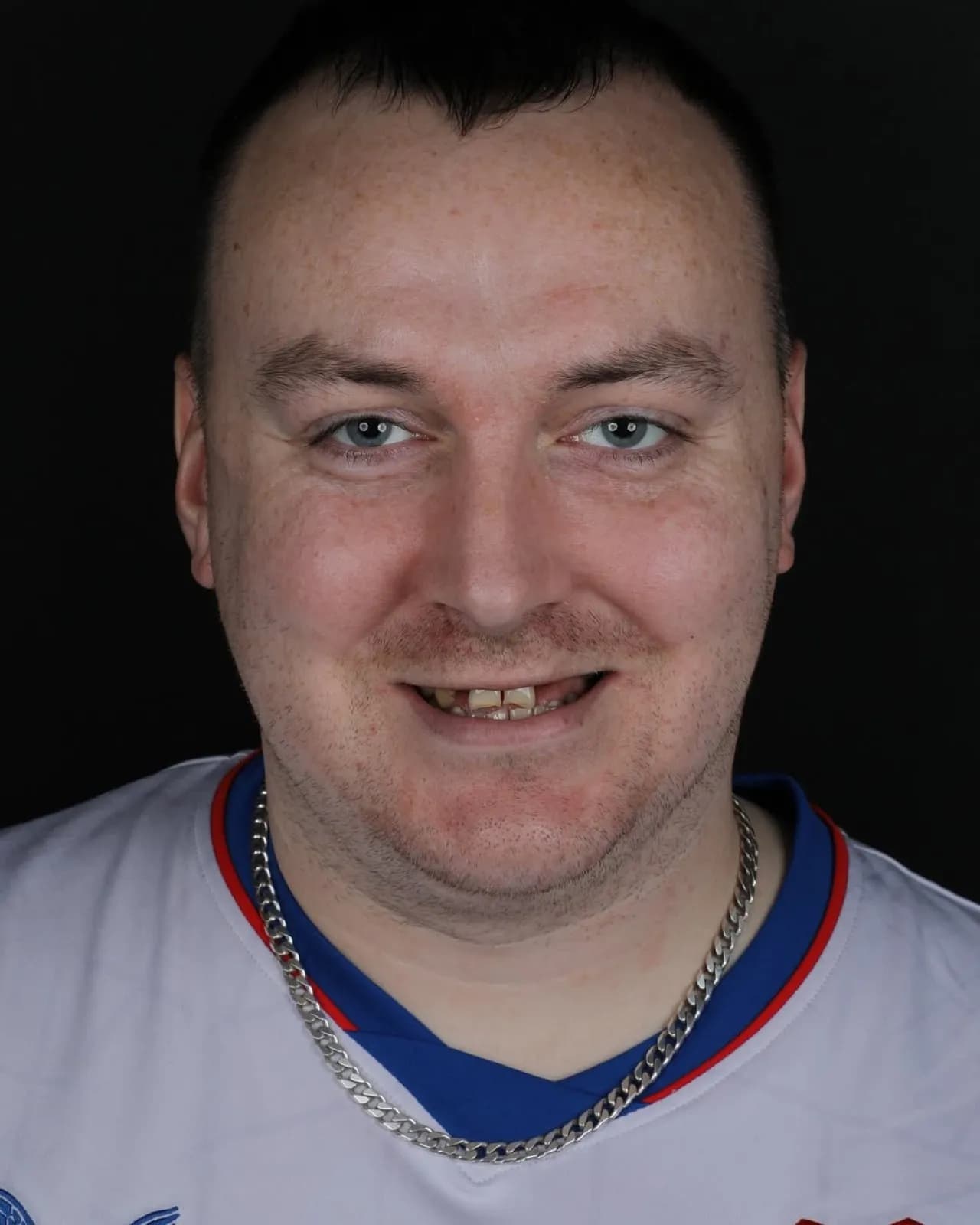Before zirconium crown treatment, full face portrait of male patient with broken front teeth, Turkey dental clinic.