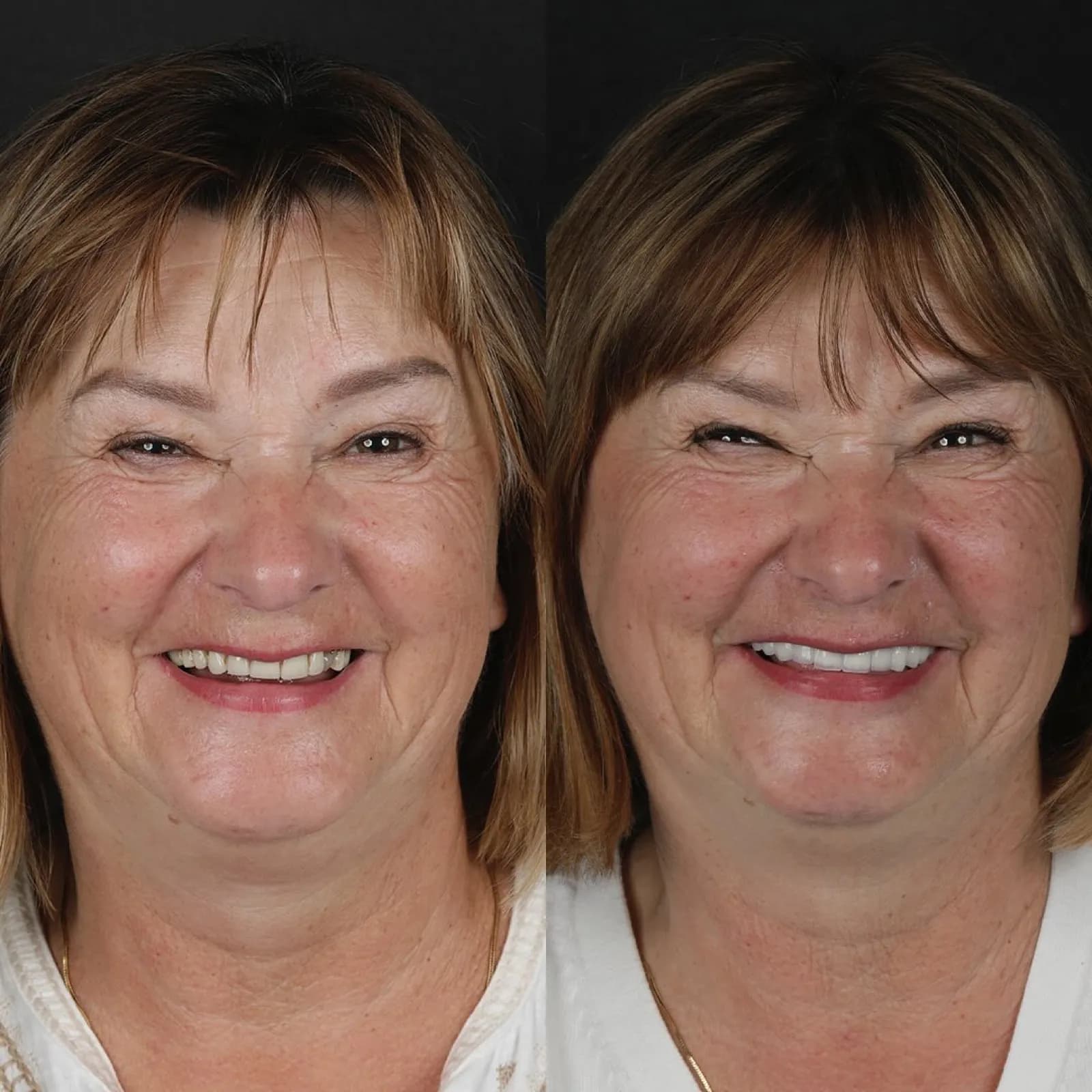 Full mouth dental implant before and after result showing complete smile transformation with All-on-Six implant supported restoration, Turkey dental clinic case.