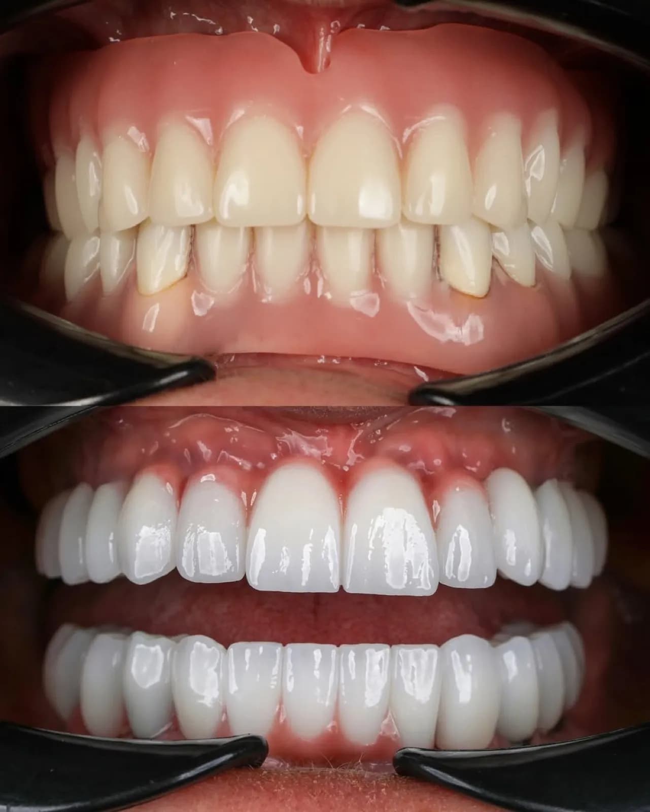 All-on-Six dental implant before and after comparison, damaged and discolored teeth replaced with a fixed, natural-looking white full-arch prosthesis, Turkey dental clinic.