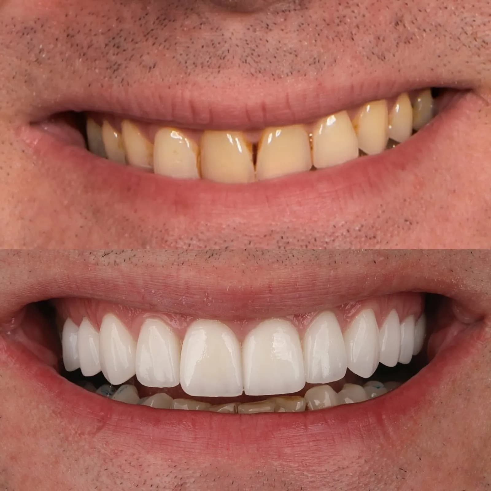 Smile makeover before and after result, close-up comparison of worn versus white teeth, Turkey dental clinic.