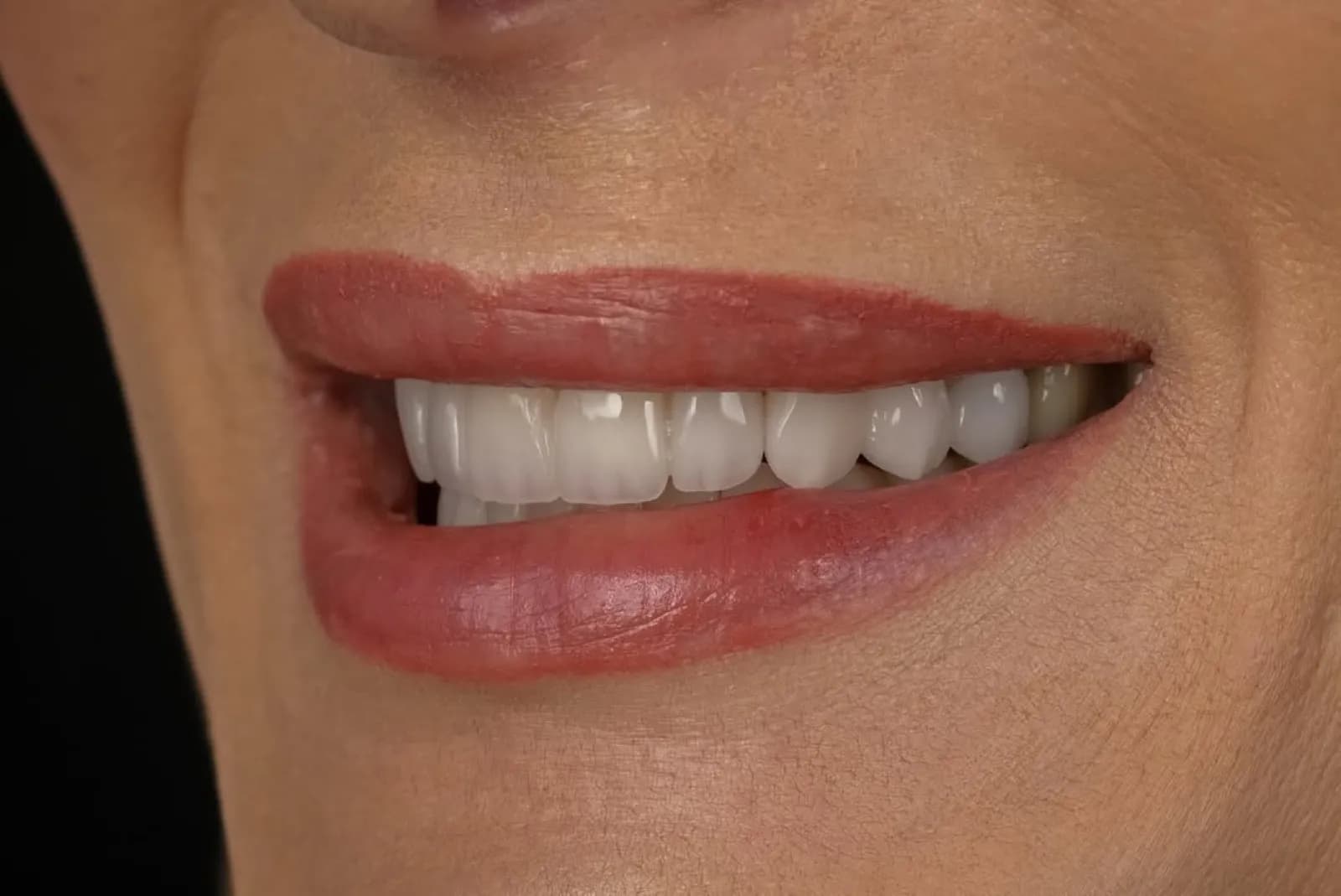 Smile makeover after result, close-up of white symmetrical front teeth, Turkey dental clinic.