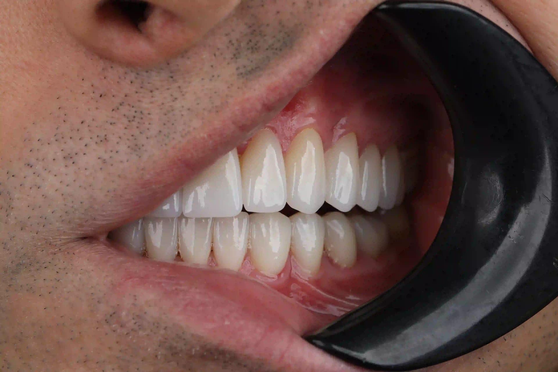 Illustrated timeline of dental implant surgery stages, from consultation and CBCT scan through placement, healing and the final crown