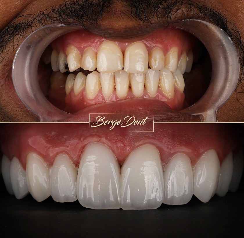 Laminate veneers and minimal preparation guide in Turkey