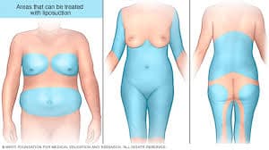Tummy Tuck in Turkey