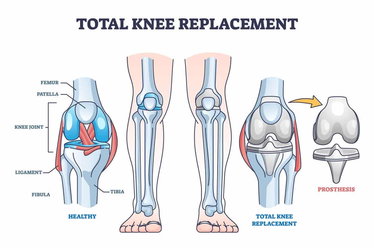 Knee replacement surgery guide and planning in Turkey