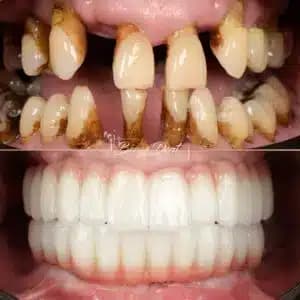 All-on-4 Turkey Cost 2026: Full Arch Implants From $3,500 Per Arch