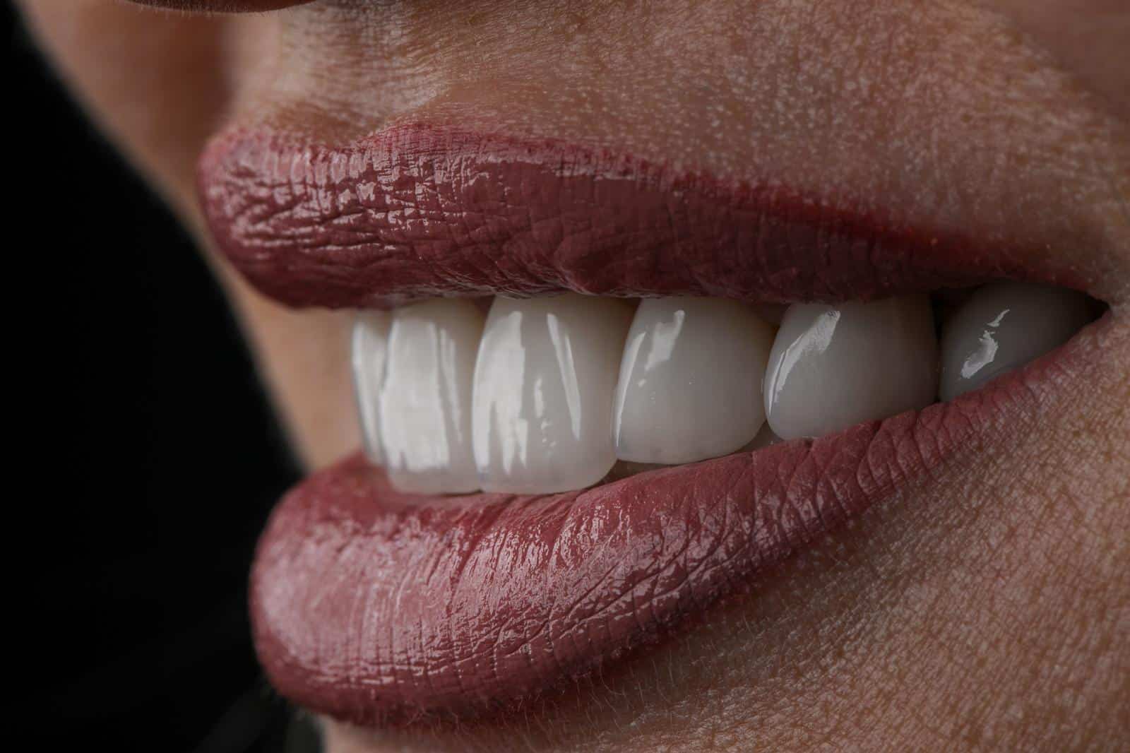 All-on-4 dental implant and same-day teeth guide in Turkey