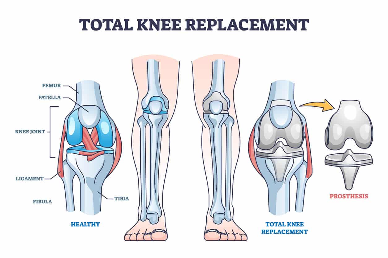 knee replacement surgery