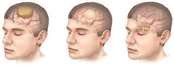 Neurology and Neurosurgery in Turkey