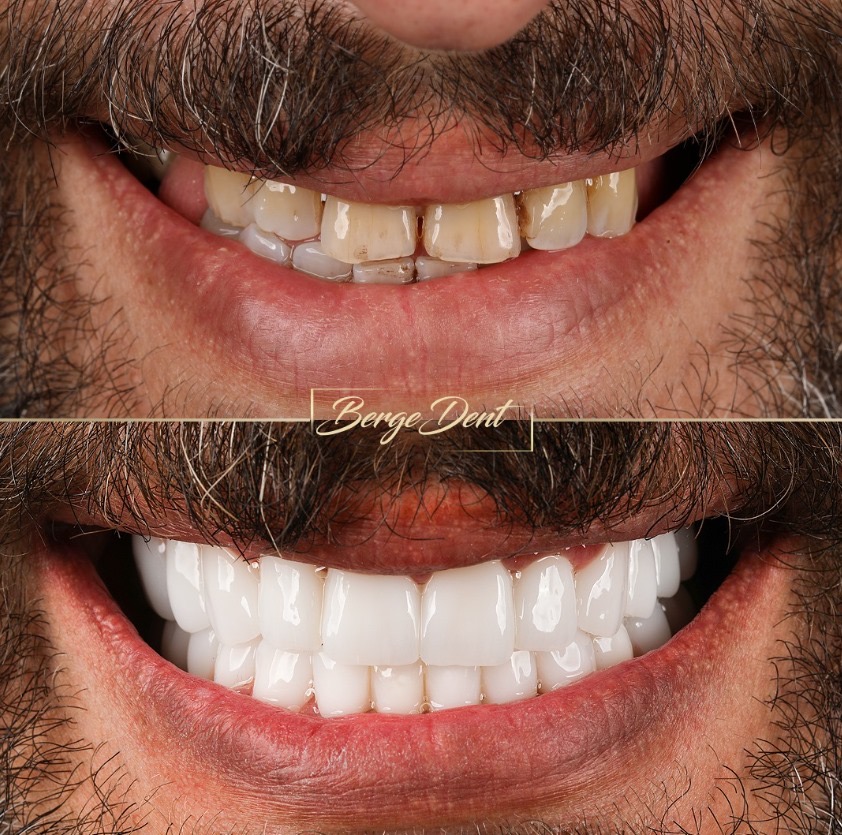 Porcelain vs Zirconia Crowns: Comparison Guide for Dental Patients
