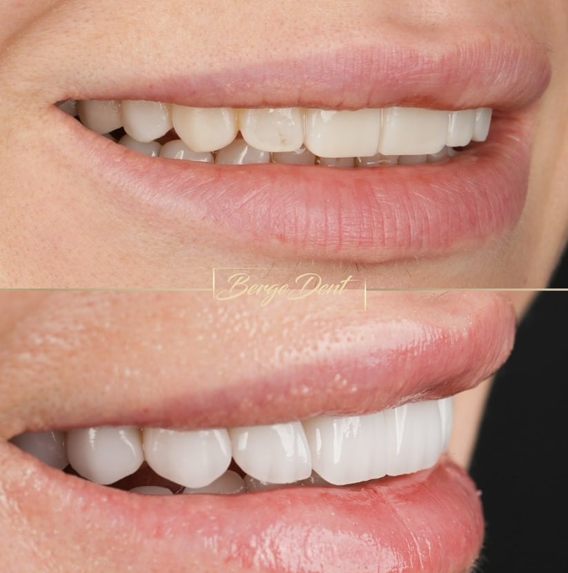 cosmetic dentistry in turkey