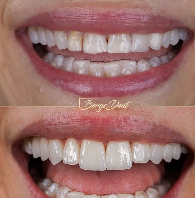 cosmetic dentistry in turkey