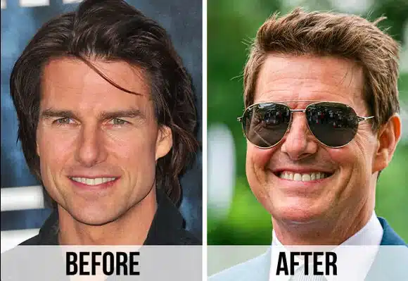 Tom Cruise smile makeover digital design example