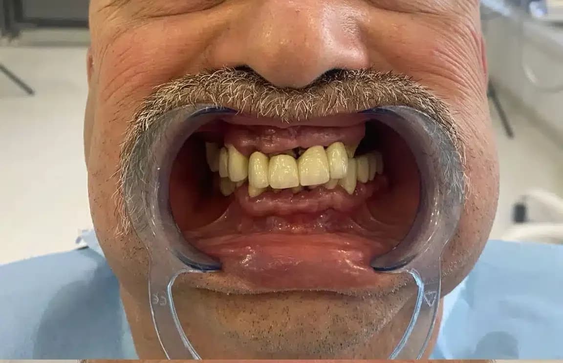 dr mehmet salih yıldırım corticobasal implants