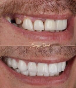 E-max Crowns vs Zirconia Crowns: Choosing the Right Material for Your Smile
