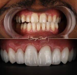 Laminate Veneers in Turkey: The Smile Secret for a Natural Transformation