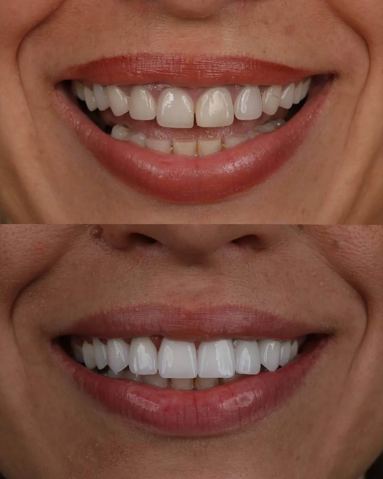 Cosmetic dentistry in Turkey — before and after smile transformation