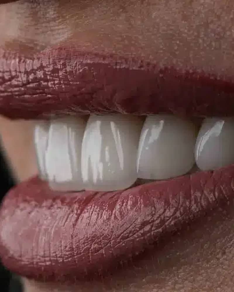 Hollywood Smile Concept