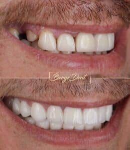 E-max Crowns vs Zirconia Crowns: Choosing the Right Material for Your Smile