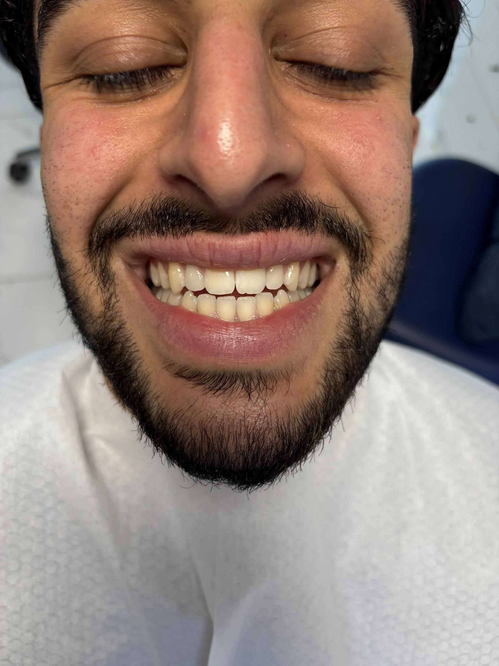 Before full-arch implant restoration — case 6, Istanbul
