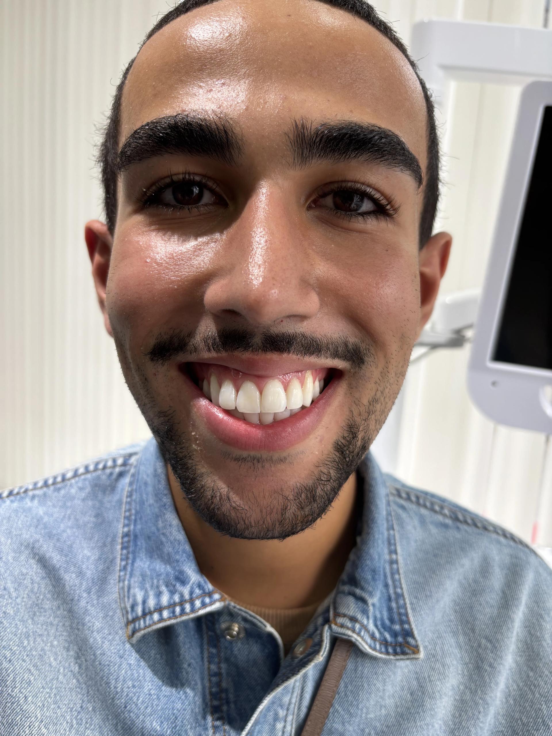 Before full-arch implant restoration — case 9, Istanbul